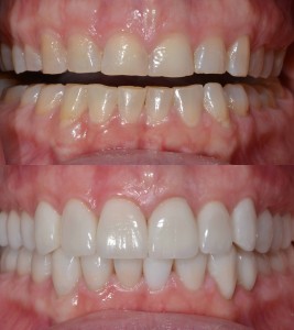 Full Mouth Restorations